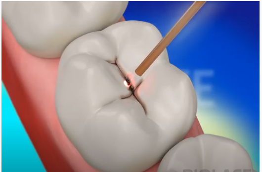 Laser Dentistry: An Innovative and Modern Dental Practice