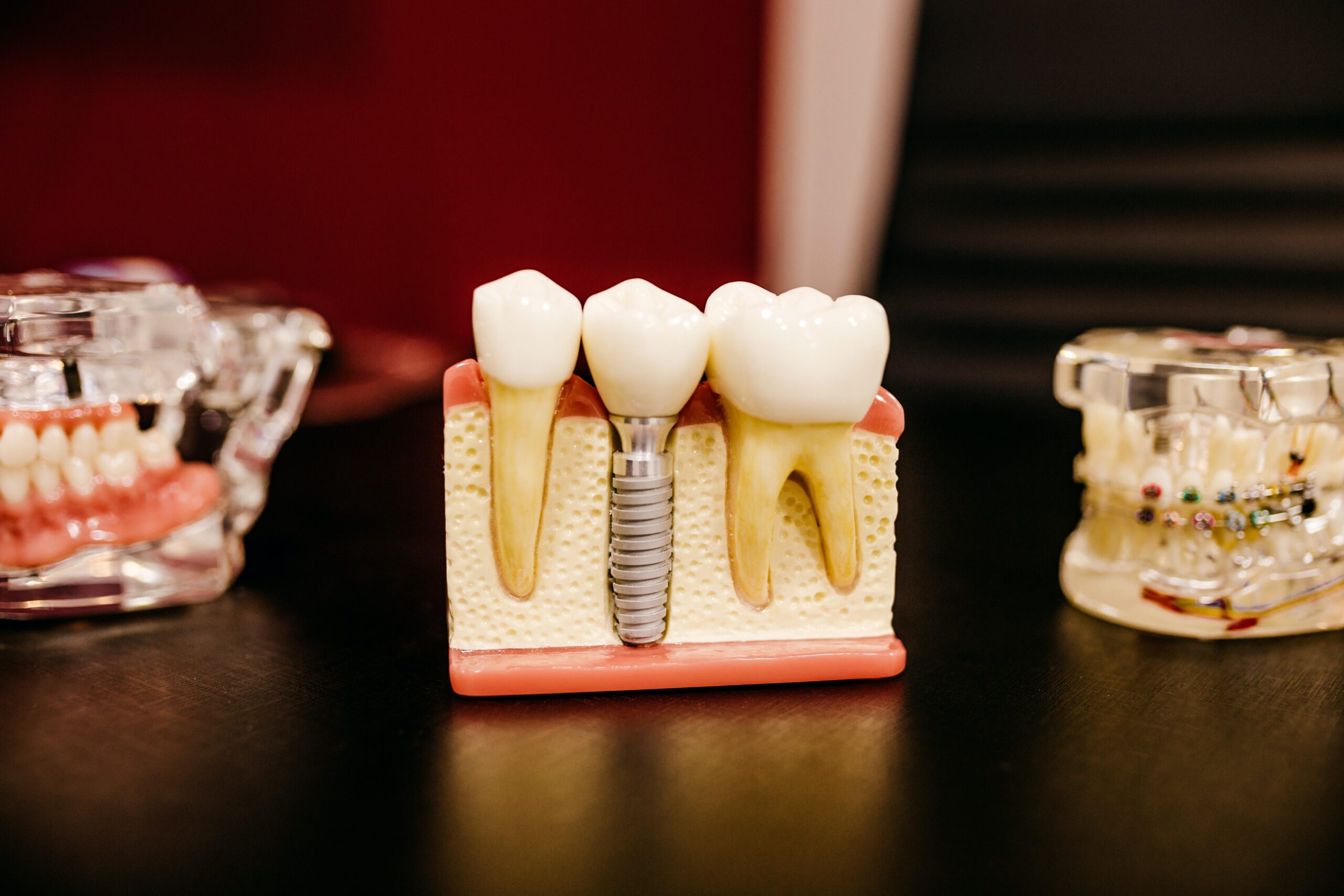 Latest Trends In Implant Dentistry